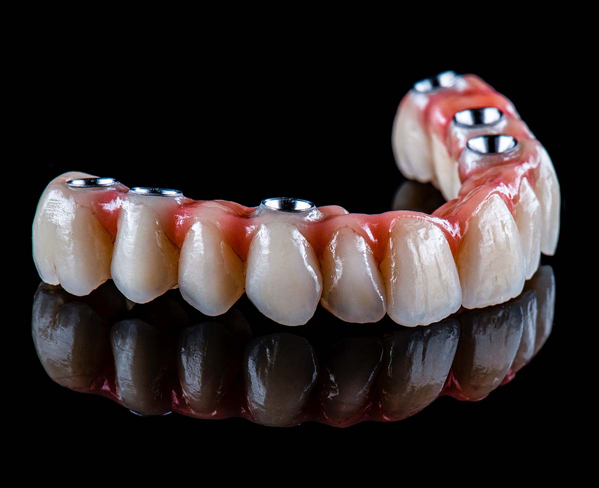 all on x dental implants