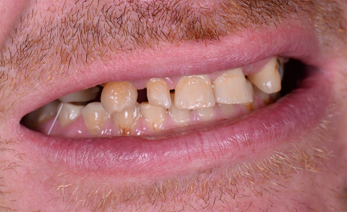 Dental Implants Before