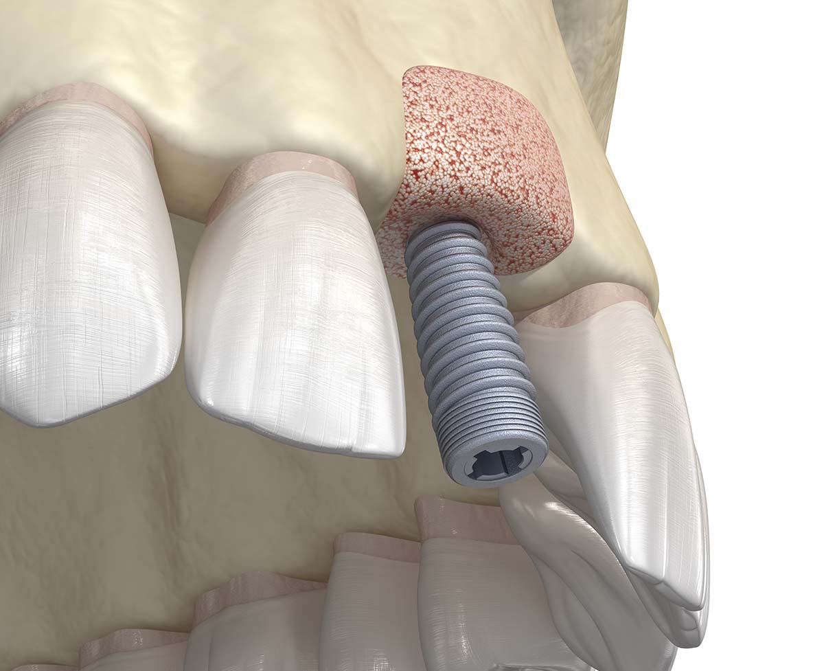 Bone Grafting for Dental Implants