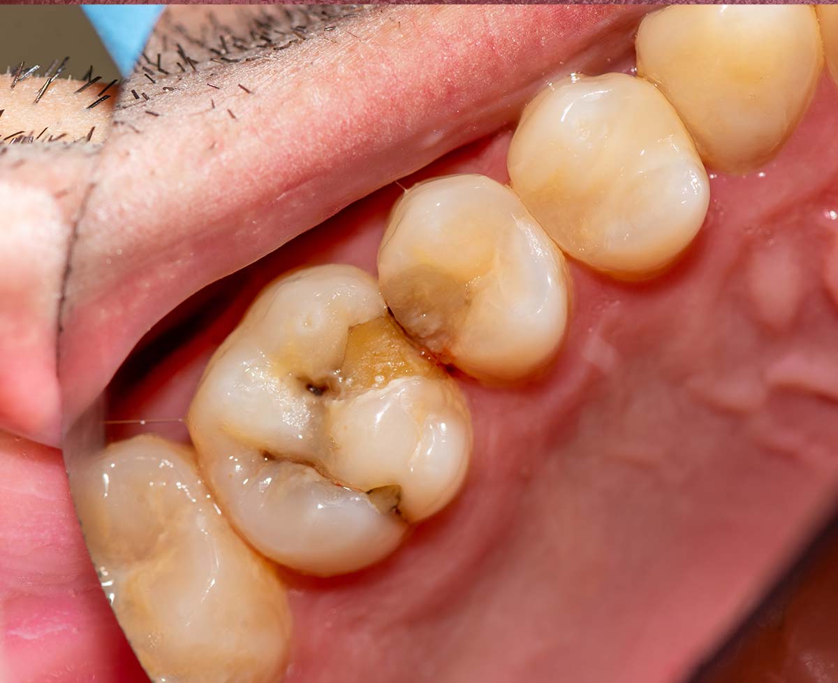 Cavity before photo