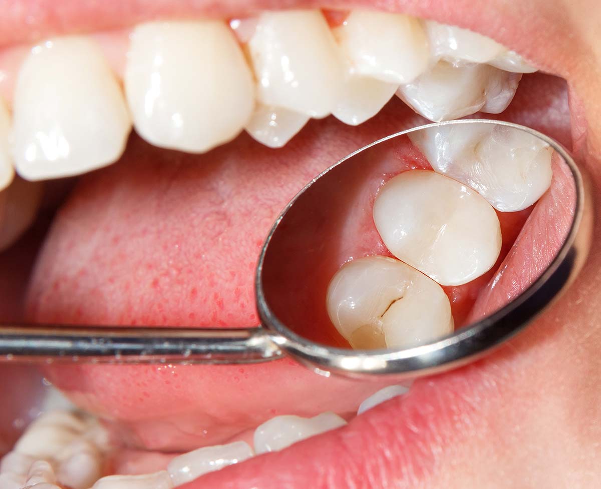 Composite Fillings After