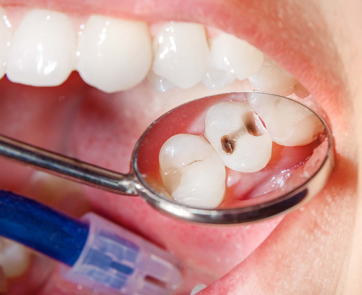 Composite Fillings Before
