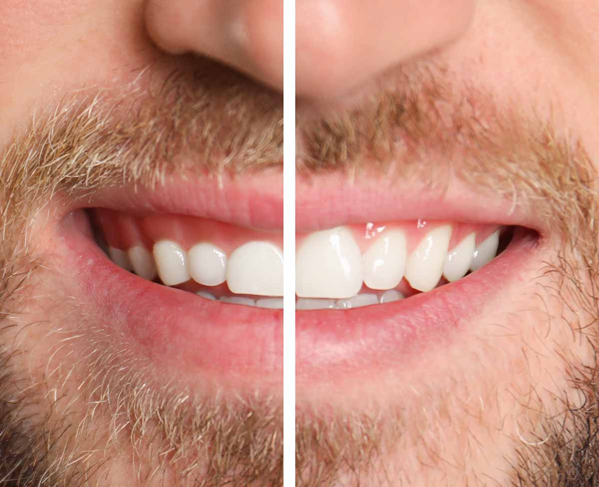 Los Angeles Gum Contouring