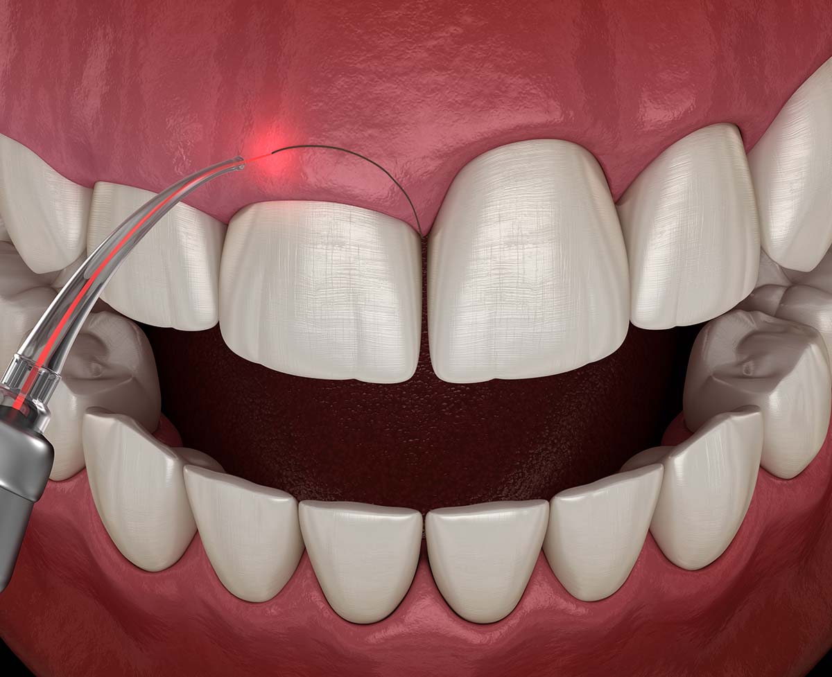 Gum Contouring process