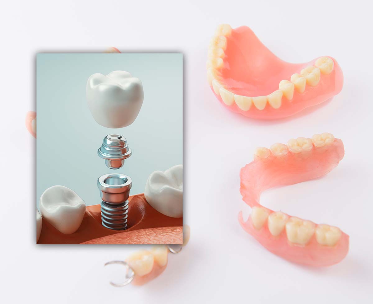 dental implants vs. Dentures