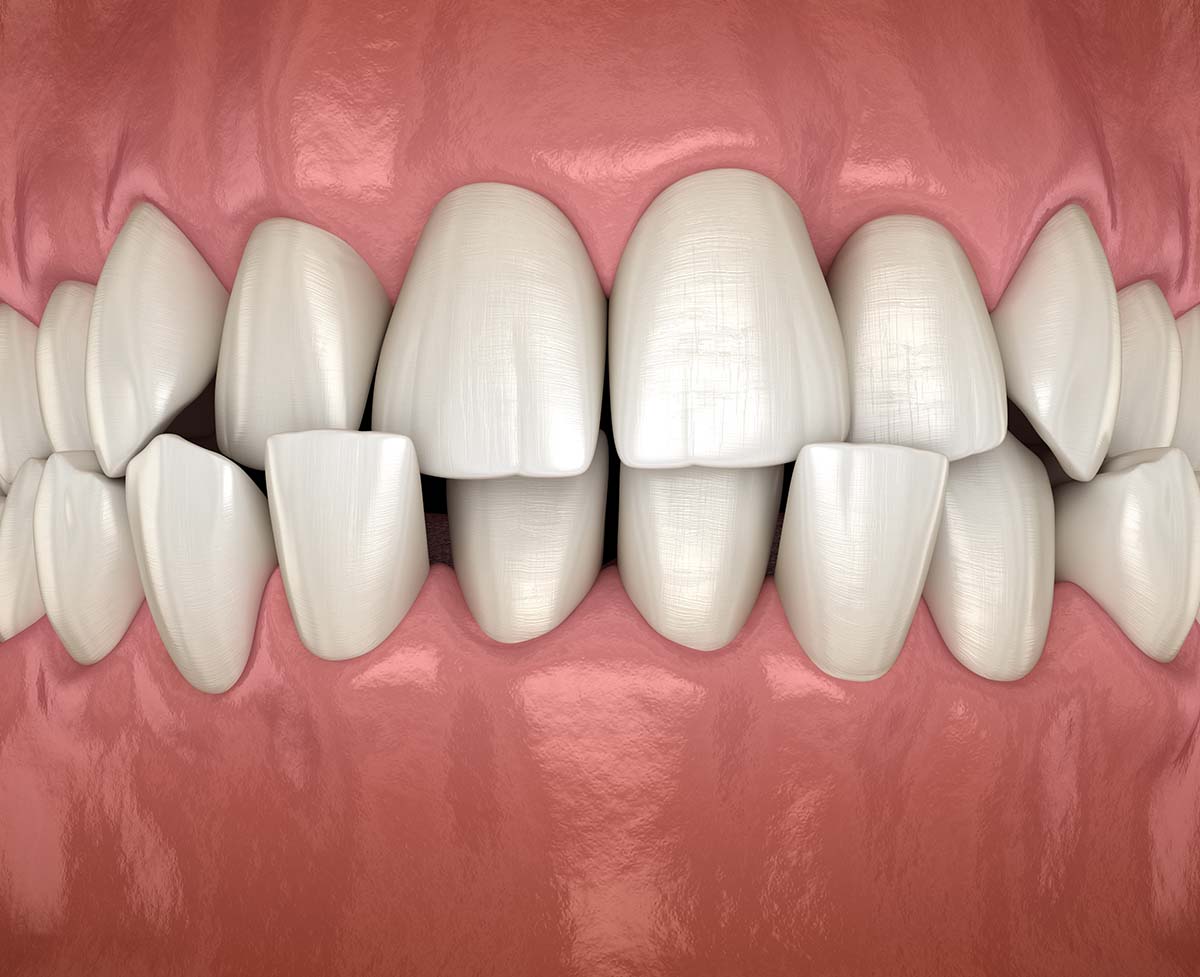 Misaligned Teeth