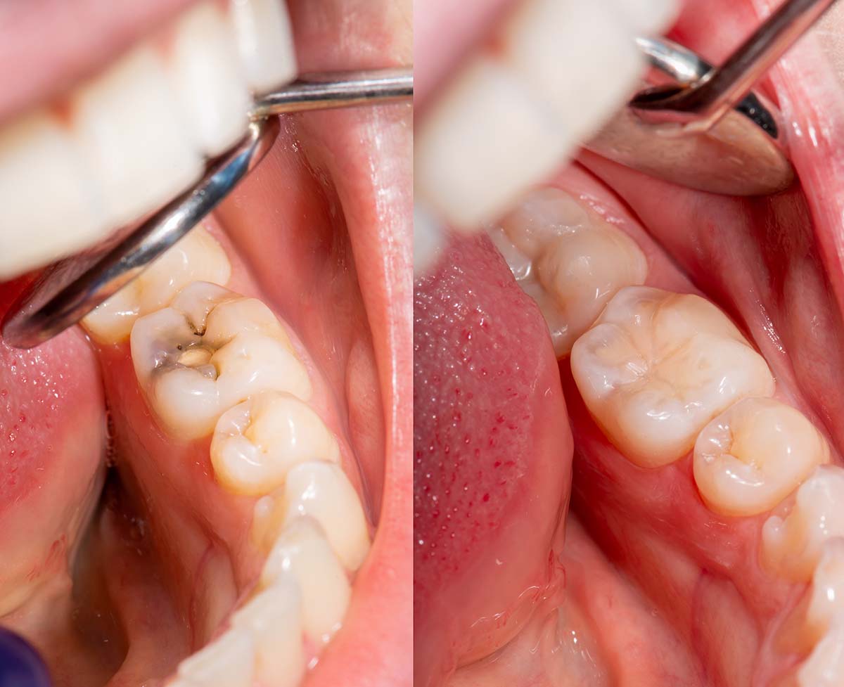 non metal fillings Los Angeles