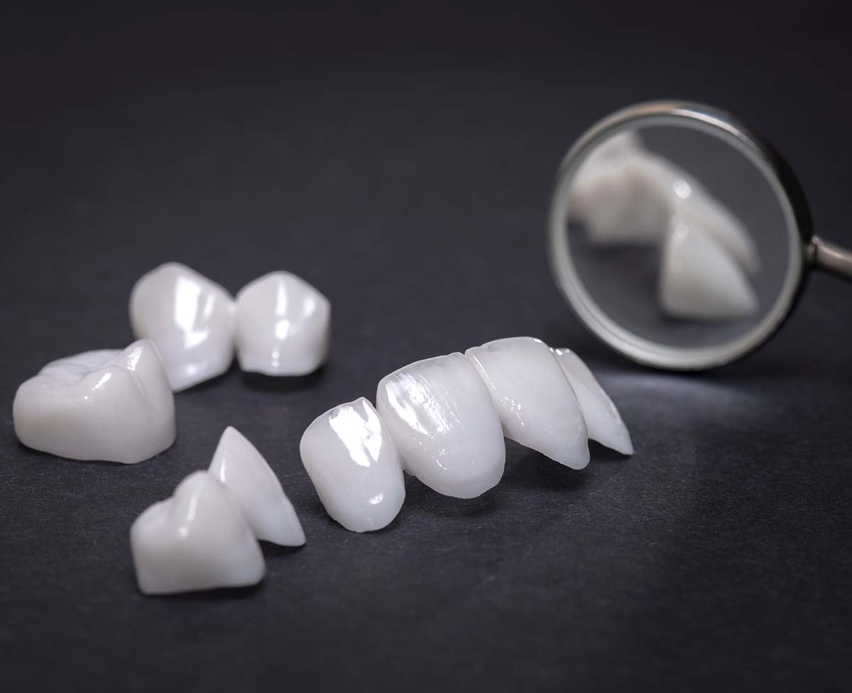 porcelain Veneers