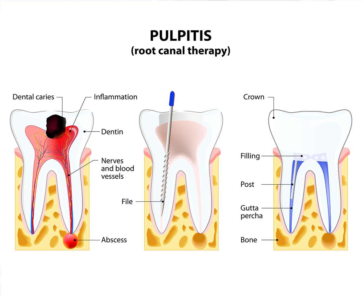 root-canal root canal Los Angeles