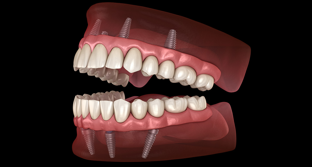 All on X Dental Implants Los Angeles
