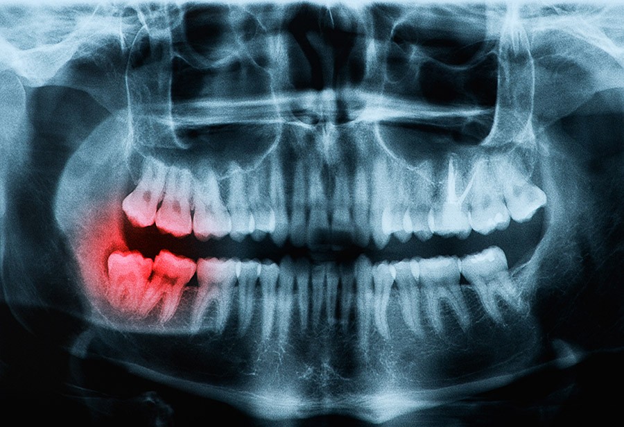 Wisdom Teeth Removal Cost in Los Angeles
