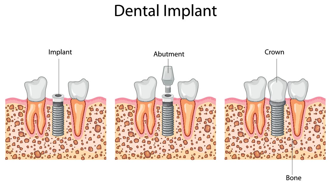 Dental Implant Infographic steps