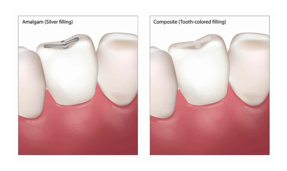 tooth color filling