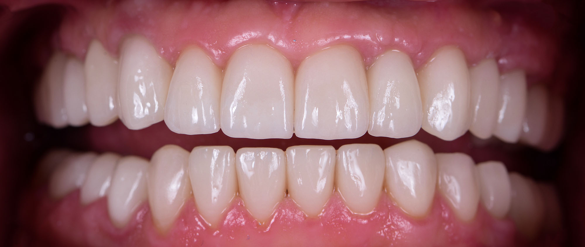 dental implants before and after