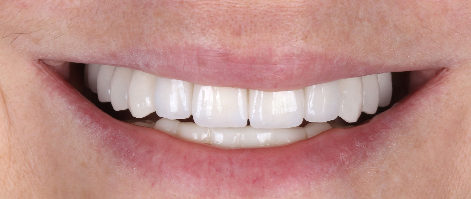 dental implants before and after