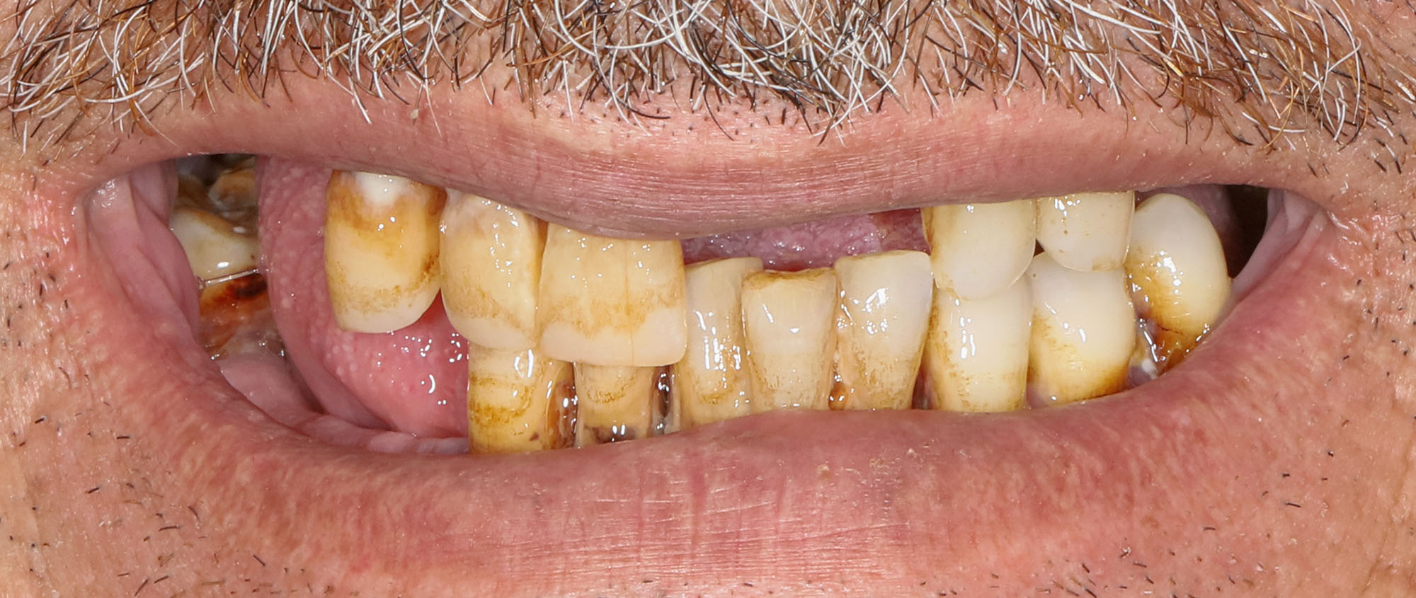 dental implants before and after